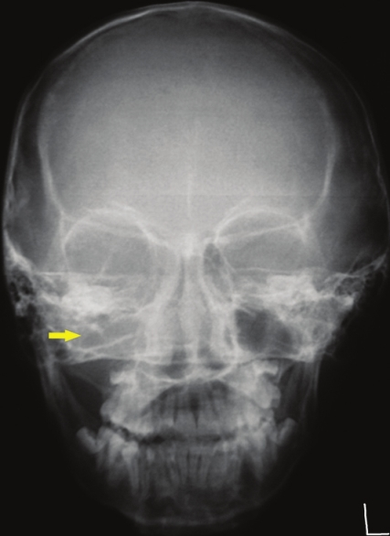 Postero-Anterior view of the skull radiograph shows diffuse opacification of the right maxillary antrum (yellow arrow).